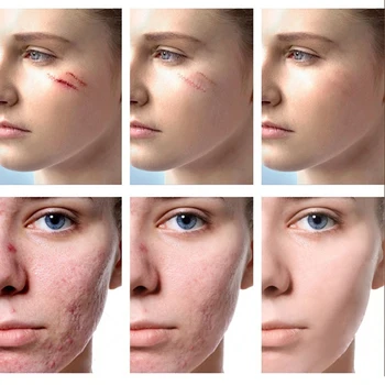 1Pc 20g Facial de la Piel de la Cicatriz del Acné Retiro de la Marca de Gel de Cuerpo Pomada Acné de Maternidad Posparto Cicatriz Reparación de Cuidado de la Piel Crema TSLM1